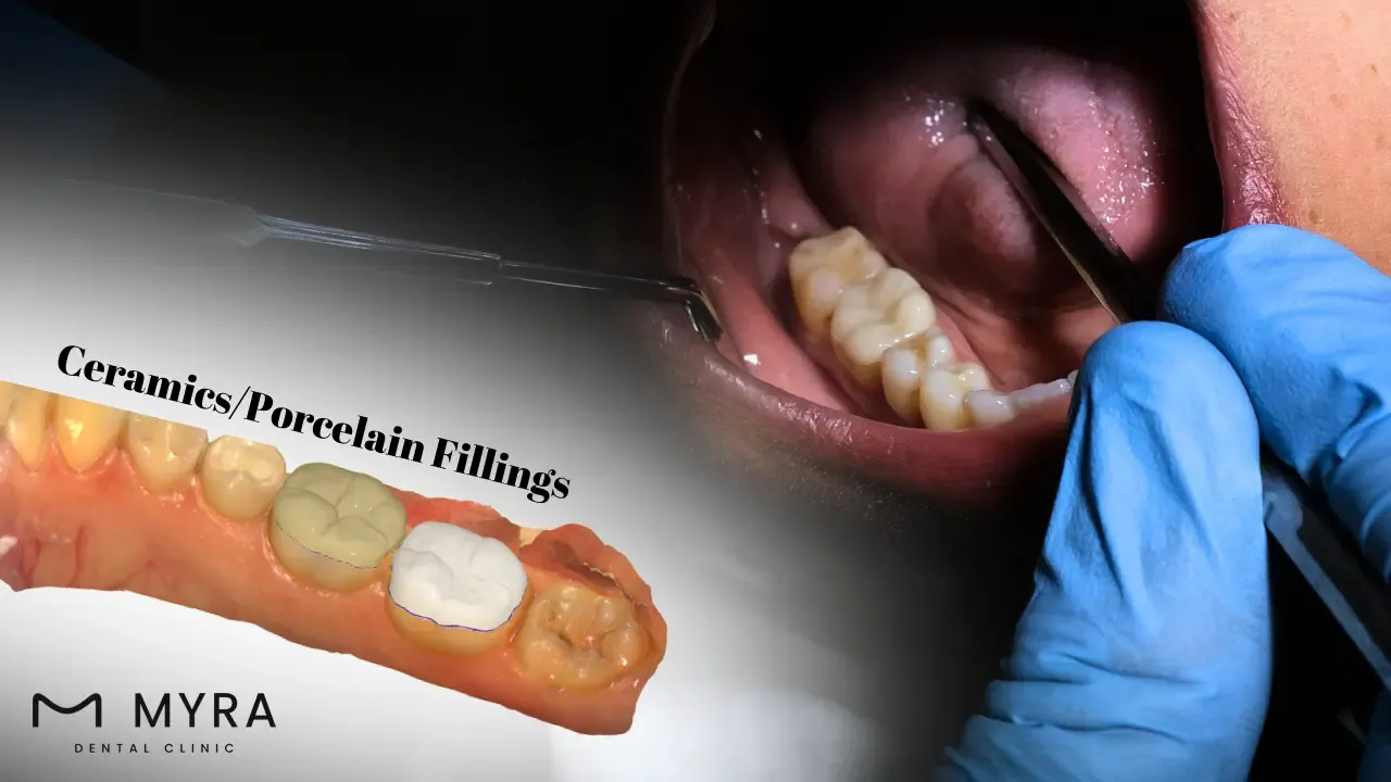 Ceramic and porcelain fillings in turkey