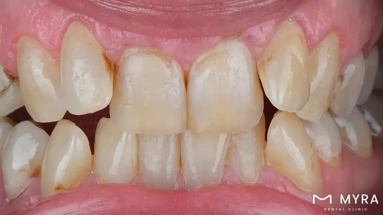 Changes in bite or tooth alignment