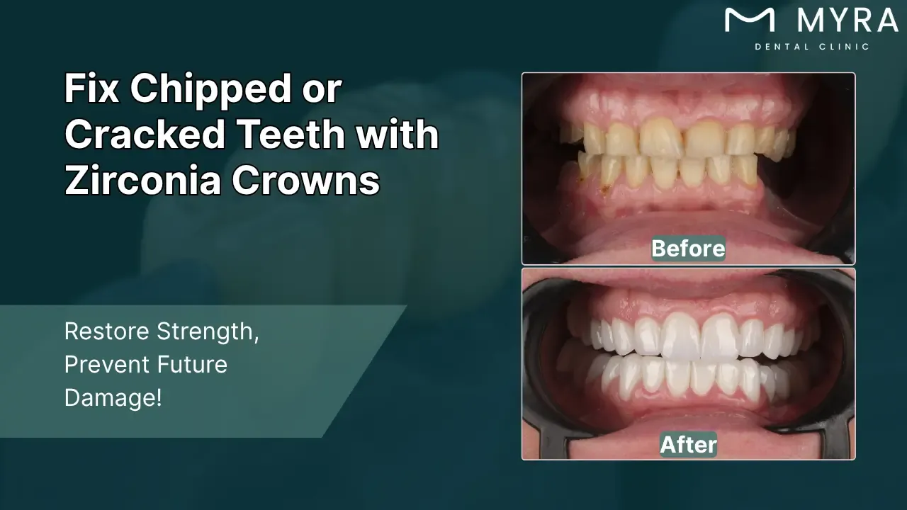 chipped or cracked teeth