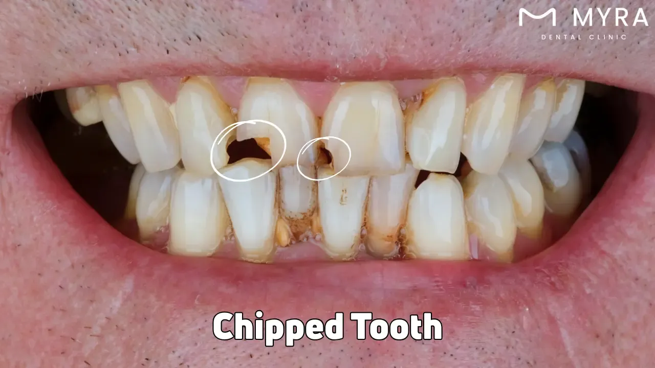 Chipped tooth