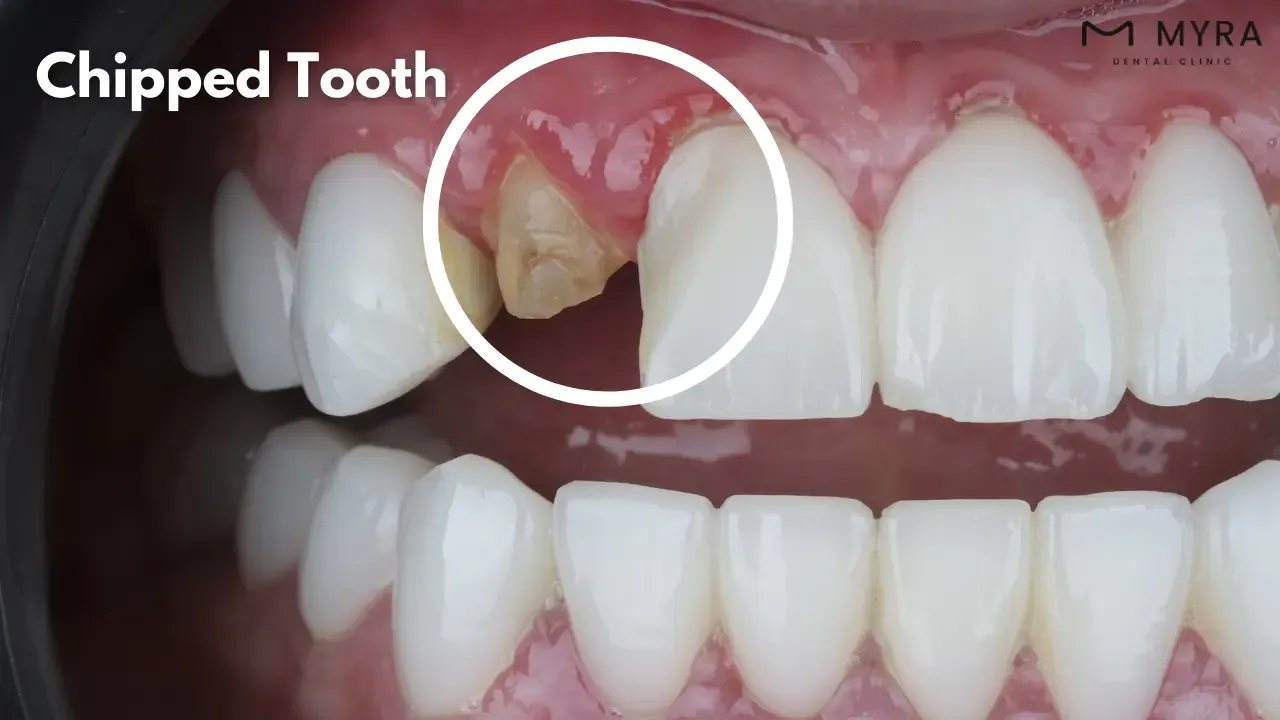 Chipped tooth symptoms in turkey