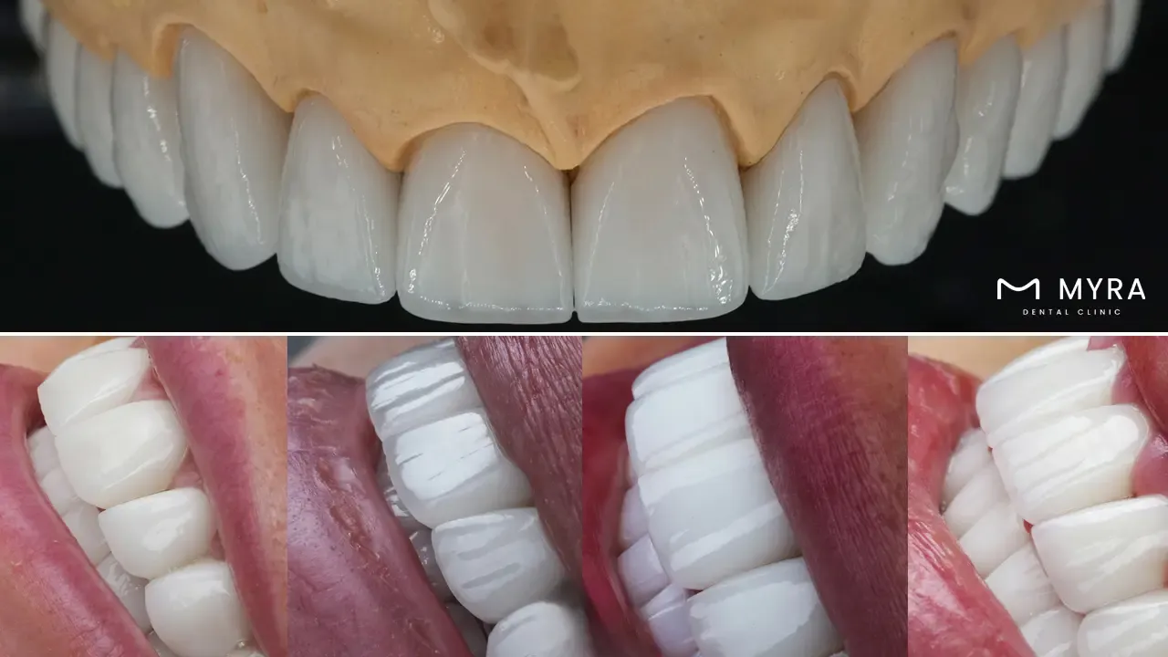 Color, shading, stains, and markings of teeth