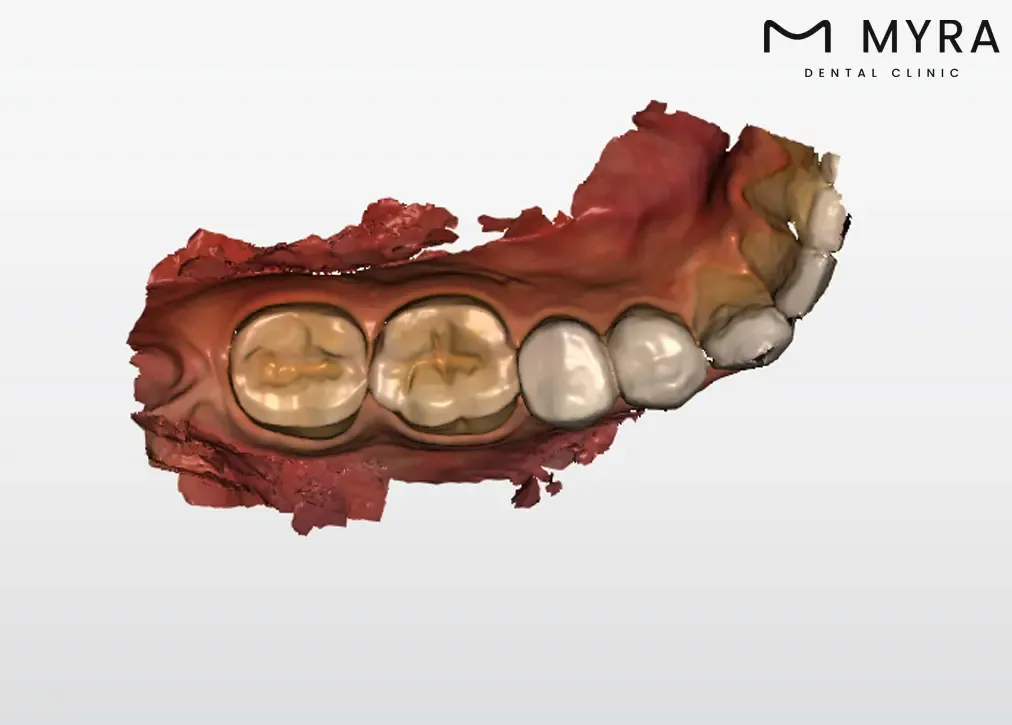 compomer-fillings.webp