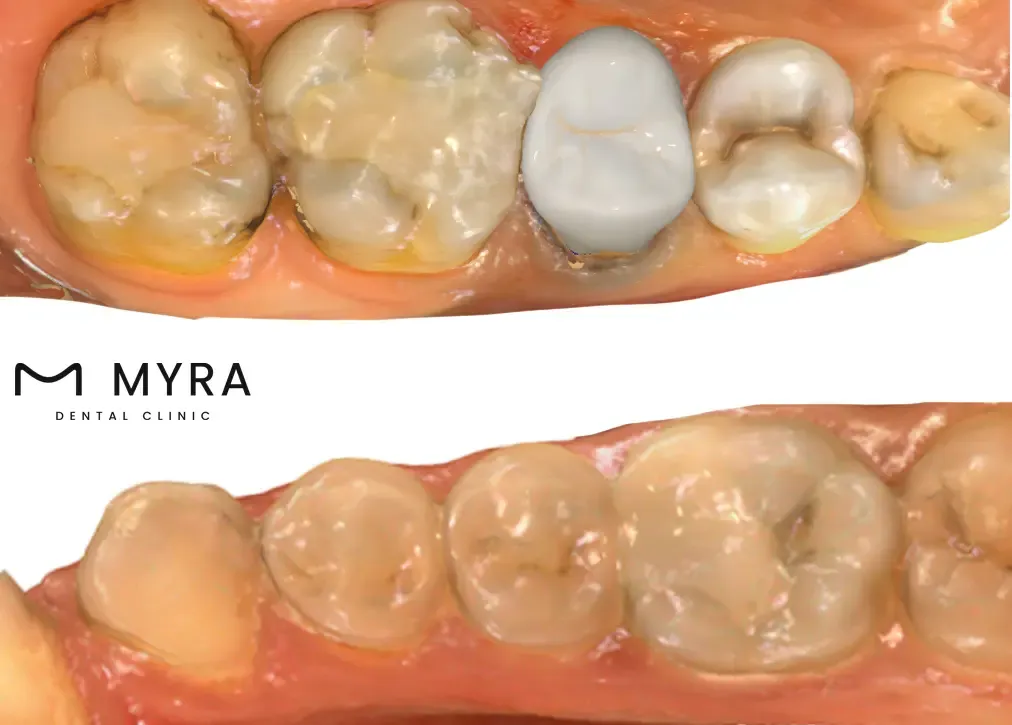 composite-fillings.webp