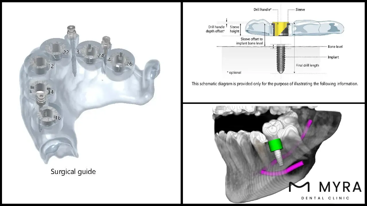 computer-guided dental implant surgery