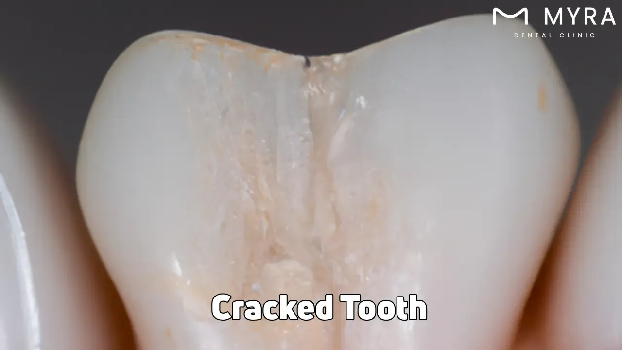 Cracked tooth