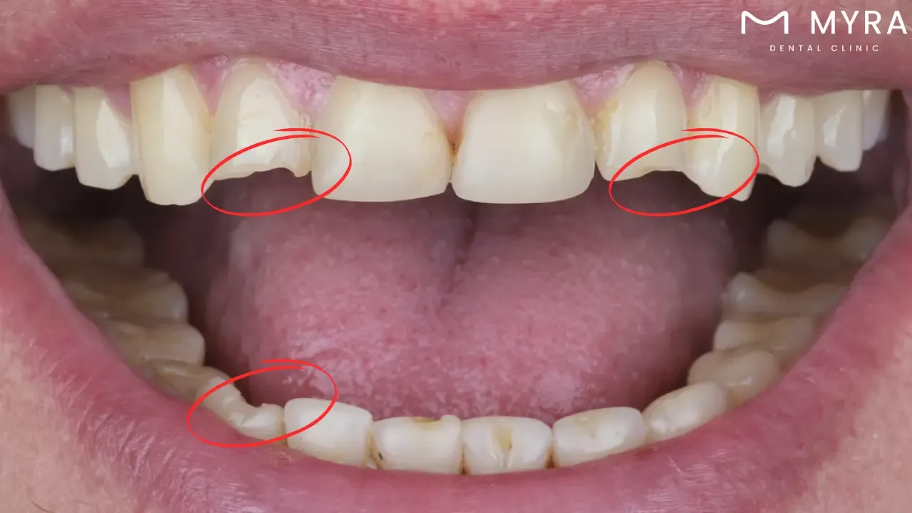 Cracked tooth: Symptoms, treatment, and causes