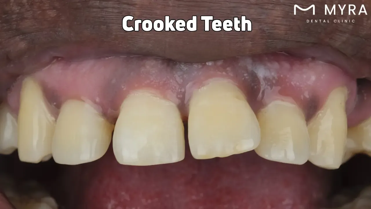 Crooked teeth