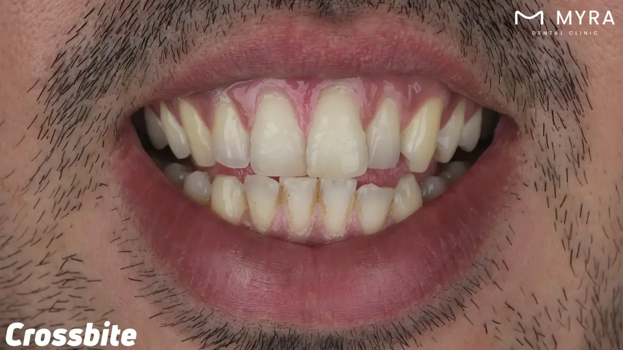 Crossbite