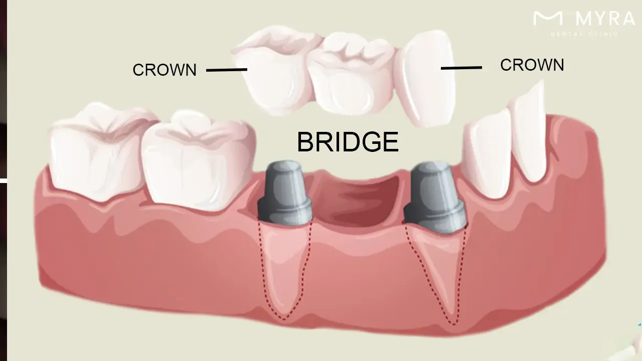 Crowns and bridges in smile design