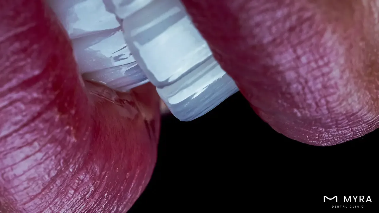 Dental amalgam fillings