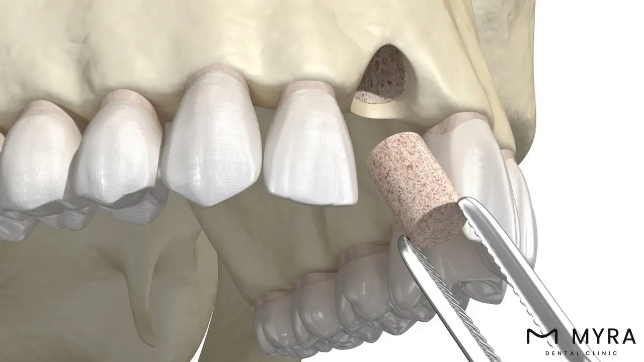 dental bone graft