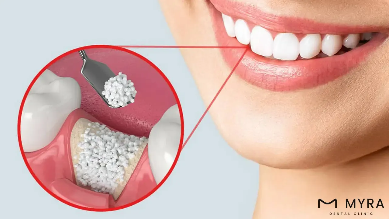 dental bone grafting