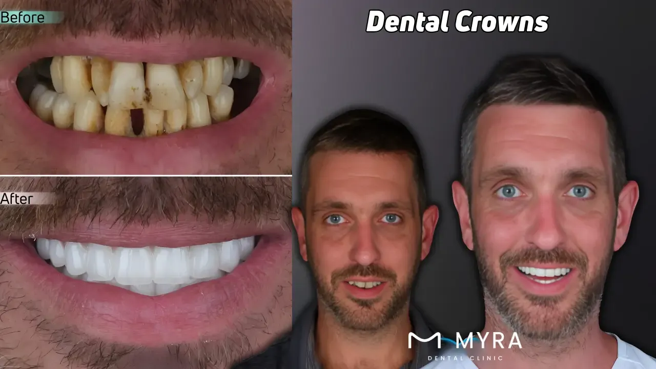 Dental crowns