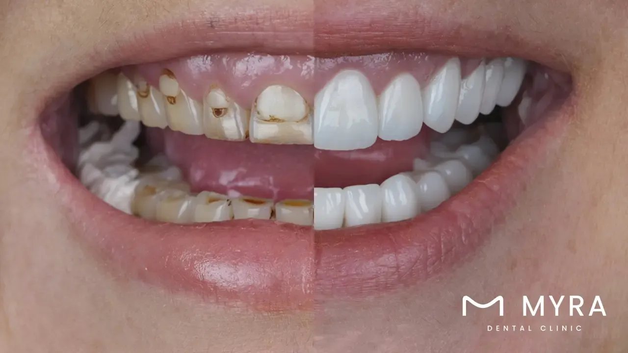 Dental crowns for maxillary central incisors