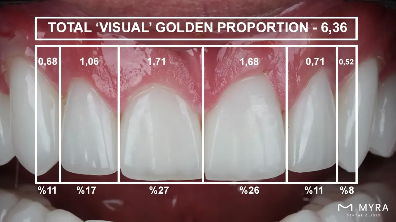 Dental golden proportion
