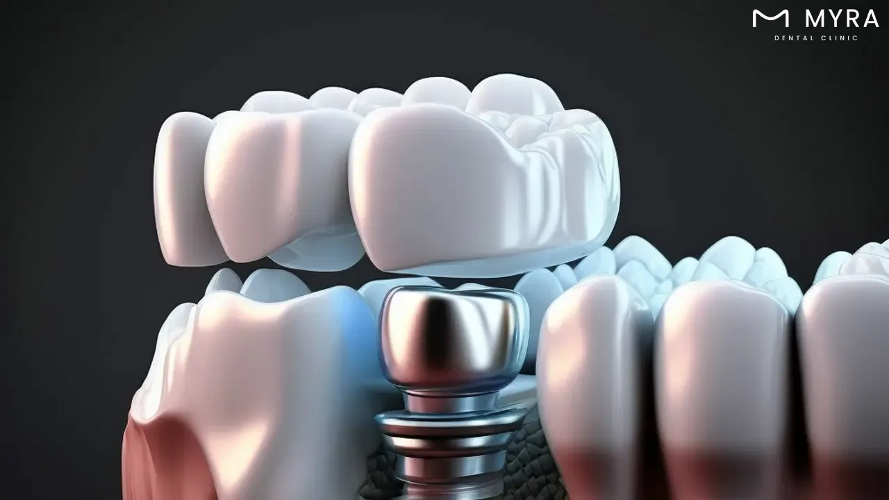 dental implant abutment
