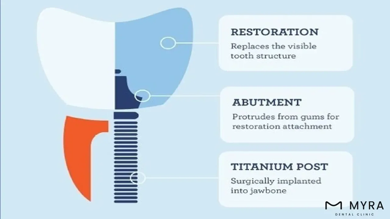 dental implant abutment
