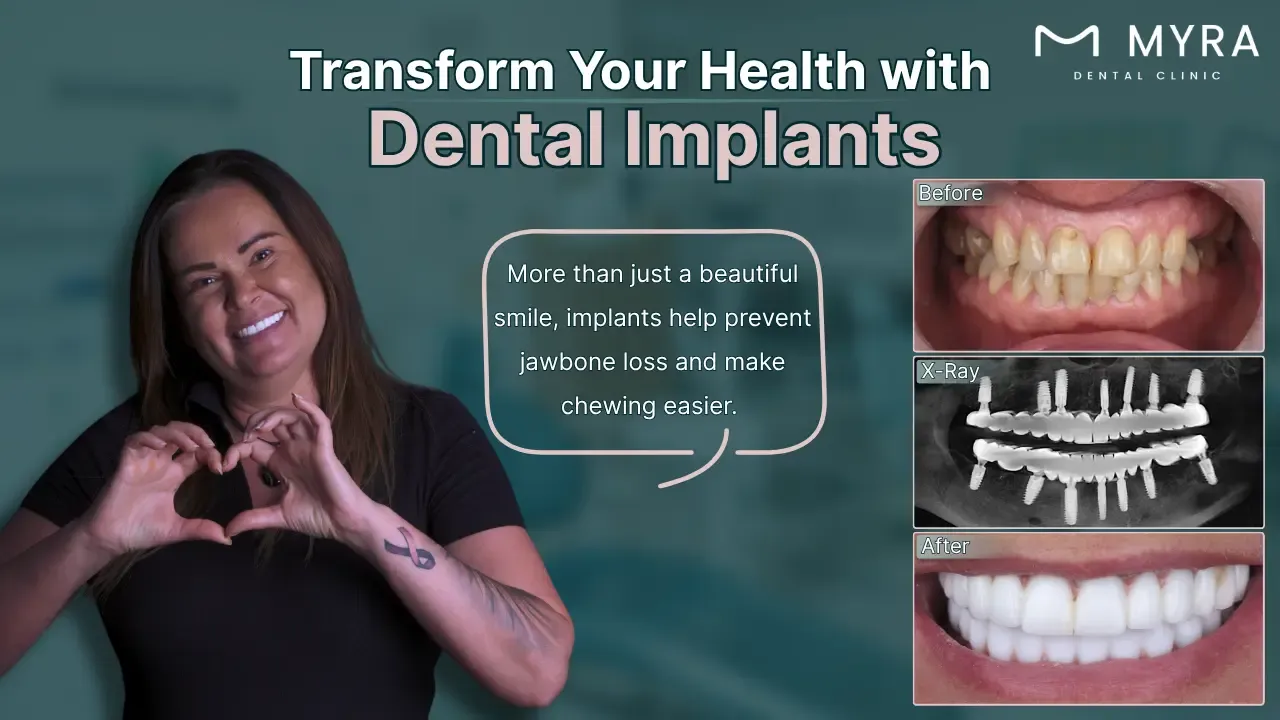 dental implant: definition, types, cost, and recovery duration