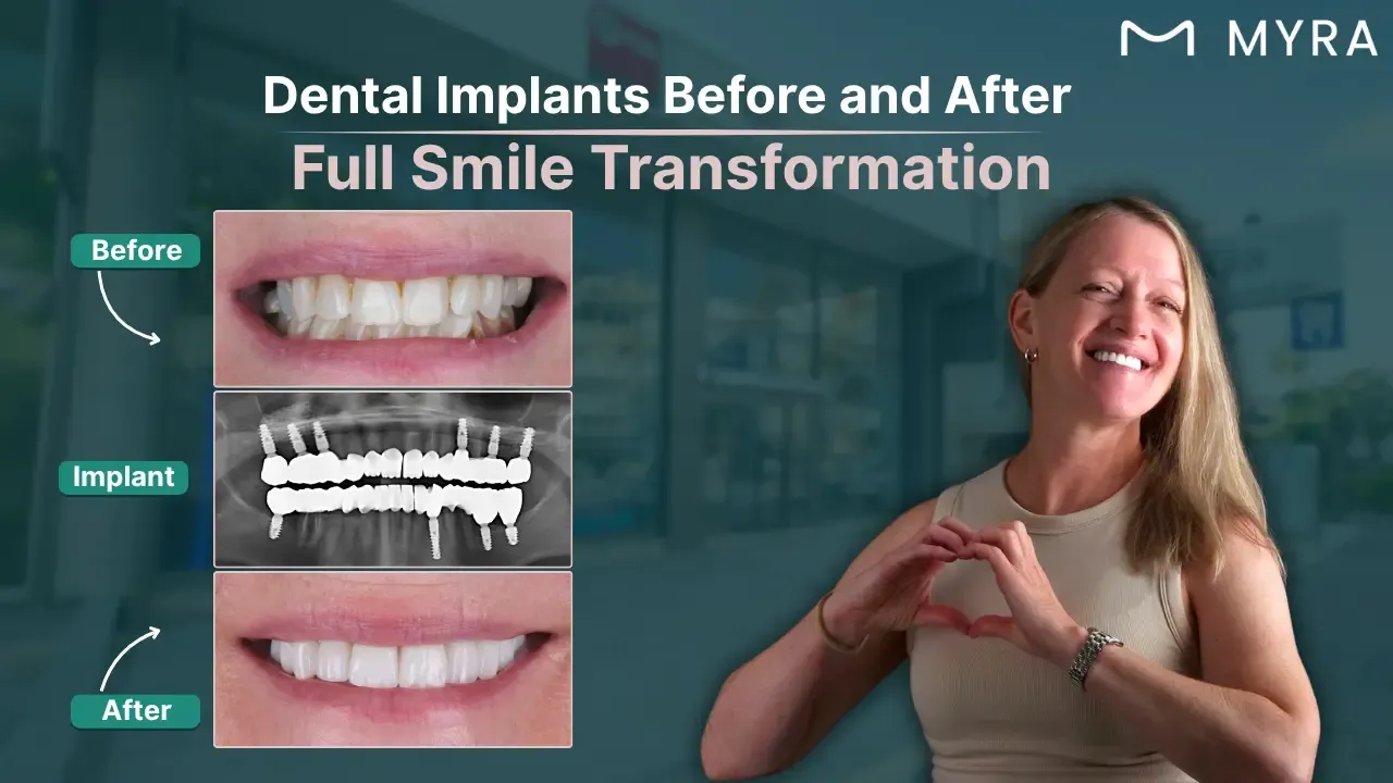 dental-implants-before-and-after-pictures.webp