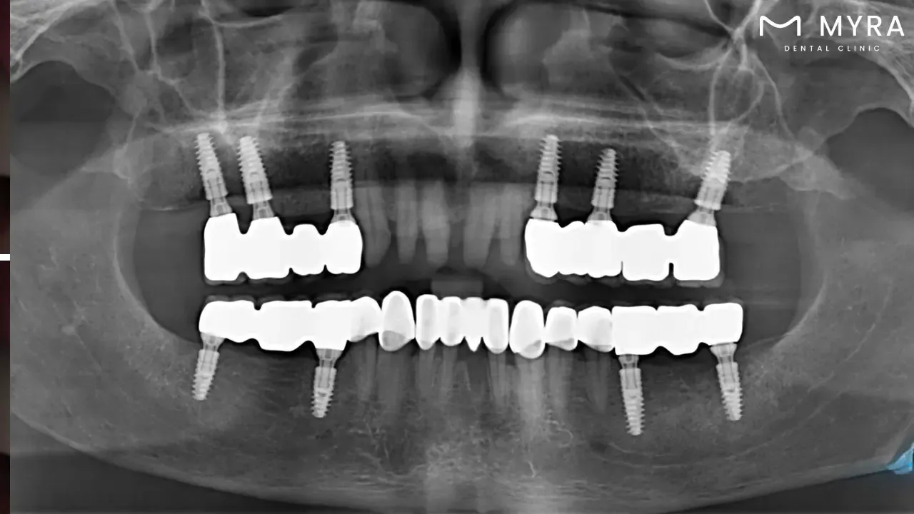 Dental implants for smile design