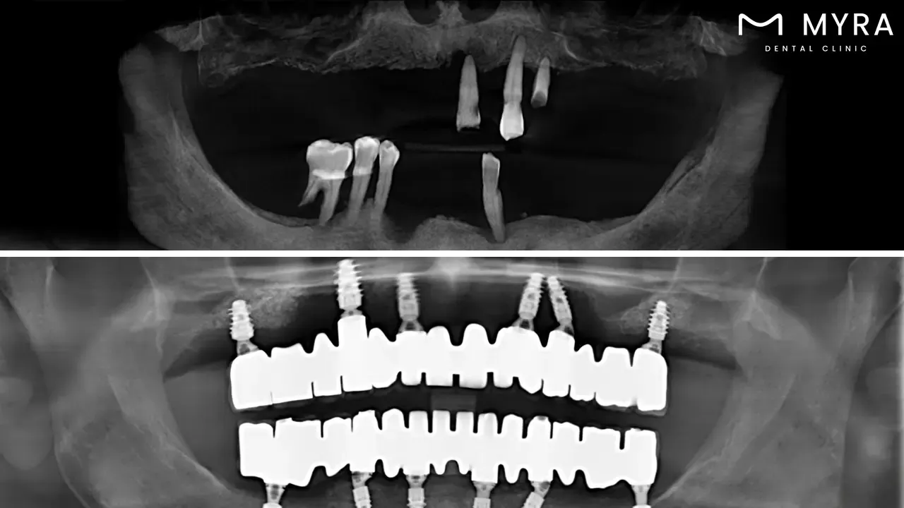 Dental implants in turkey
