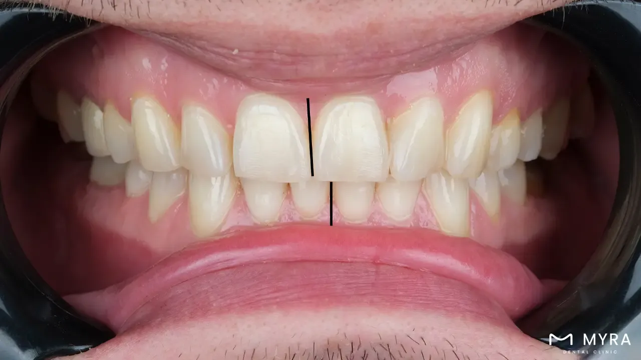 Dental midline placement