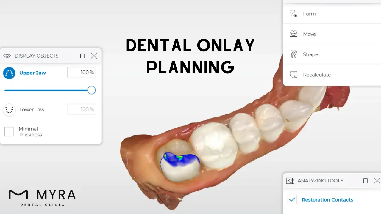 Dental onlay in turkey