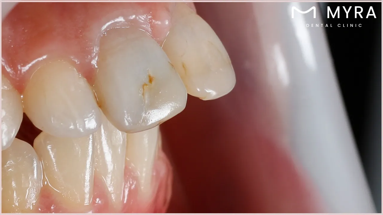 dental restorations or procedures