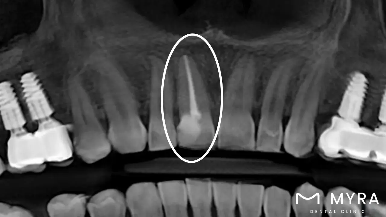 dental root canal: definition, necessity, procedure and treatment