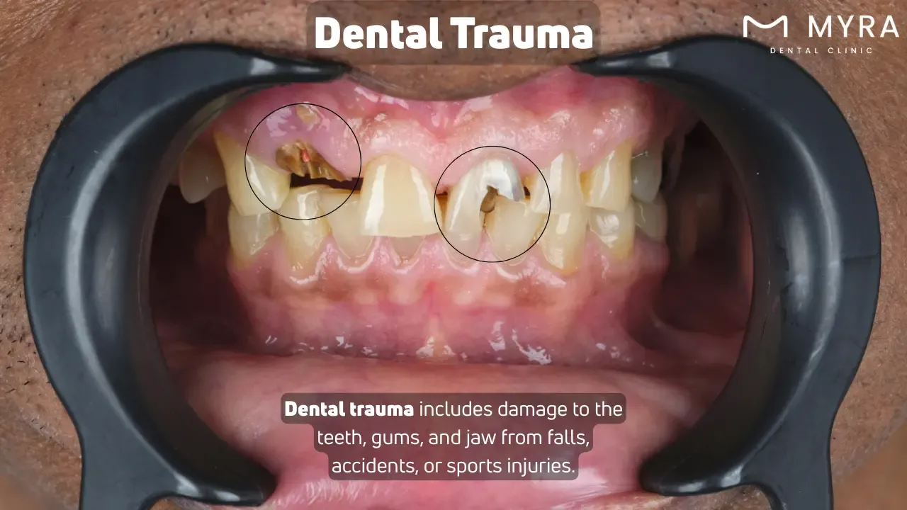 Dental trauma: Symptoms, treatment, and causes