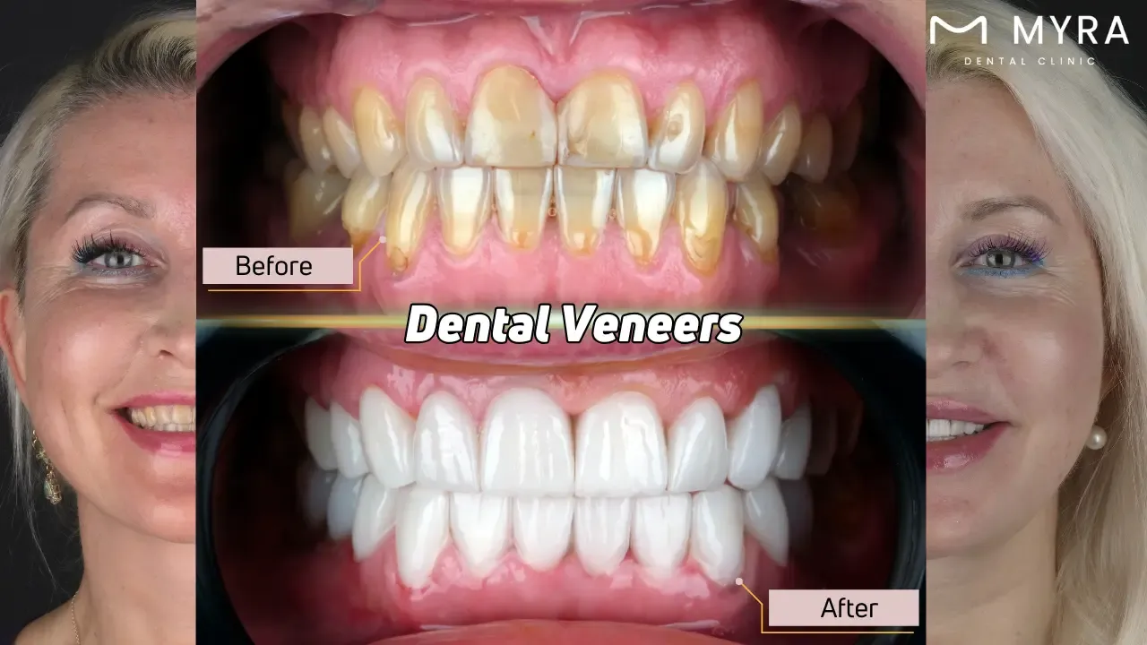Dental veneers