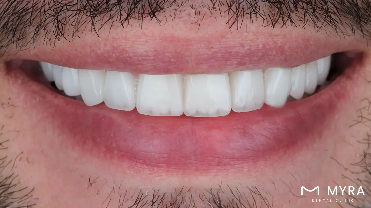 Dental veneers and facial aesthetics