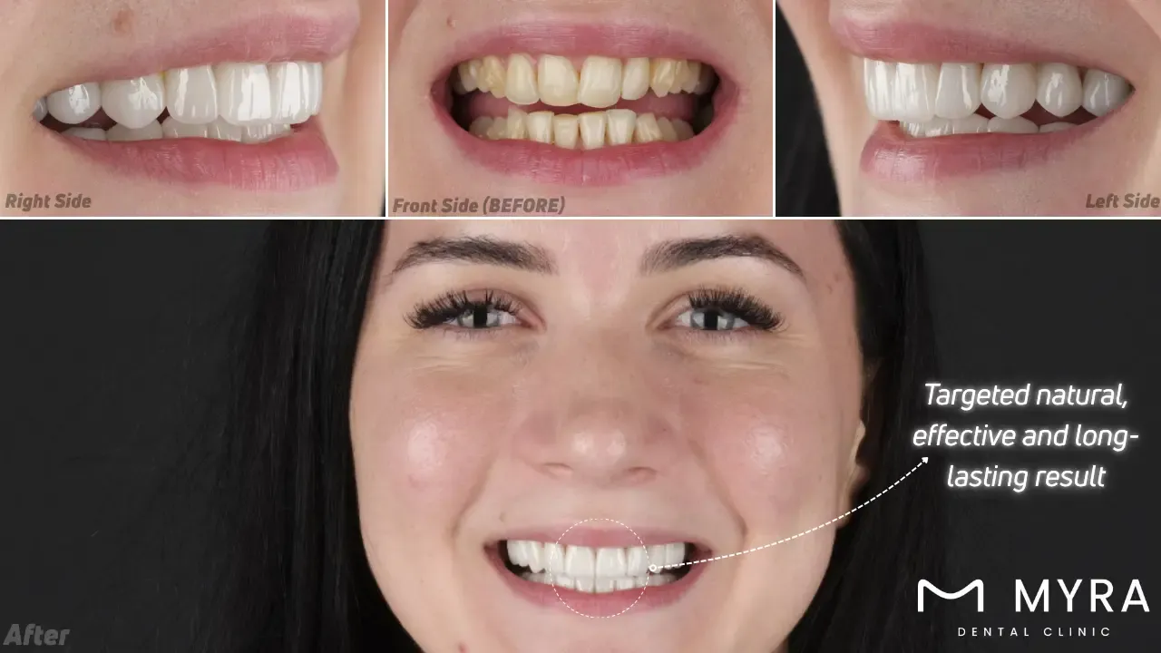 Dental veneers can help you improve self-confidence