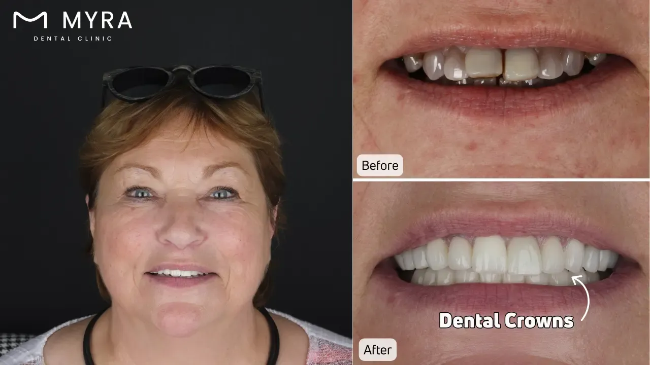  Dental veneers for black teeth