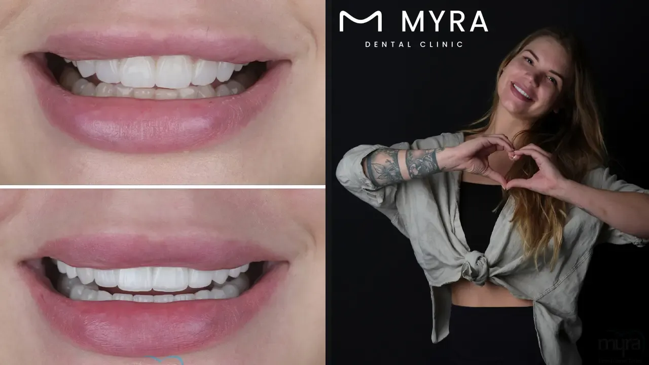 Dental veneers for maxillary central incisors