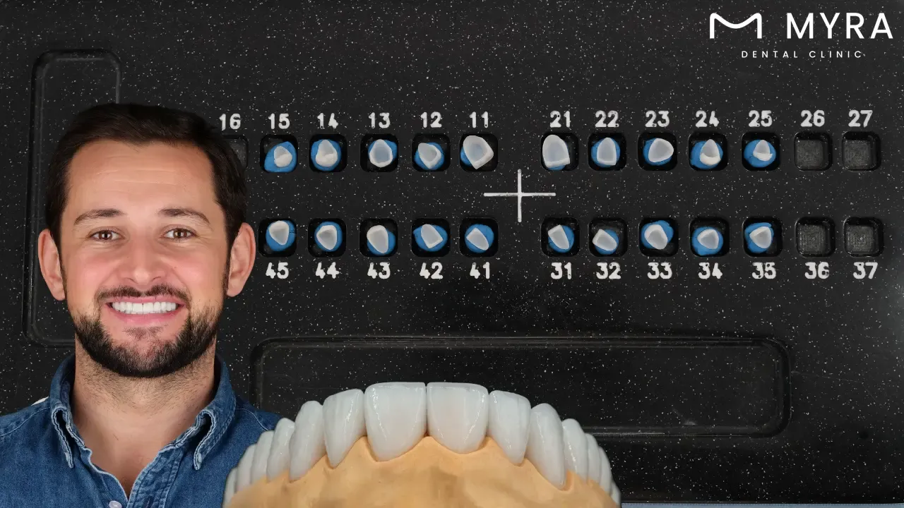 Dental veneers in turkey