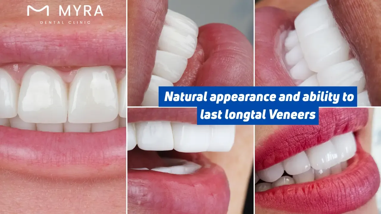 Dental veneers is durable and can last for many years