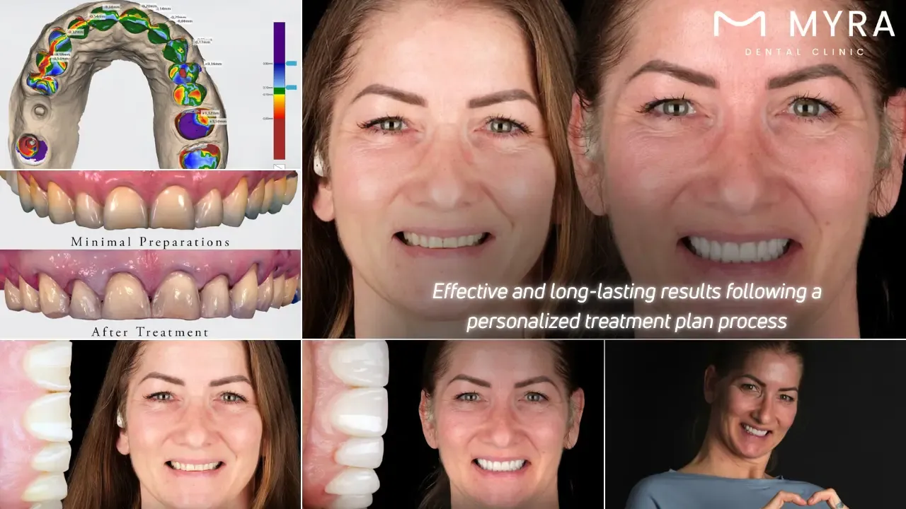 Dental veneers require minimal tooth alteration