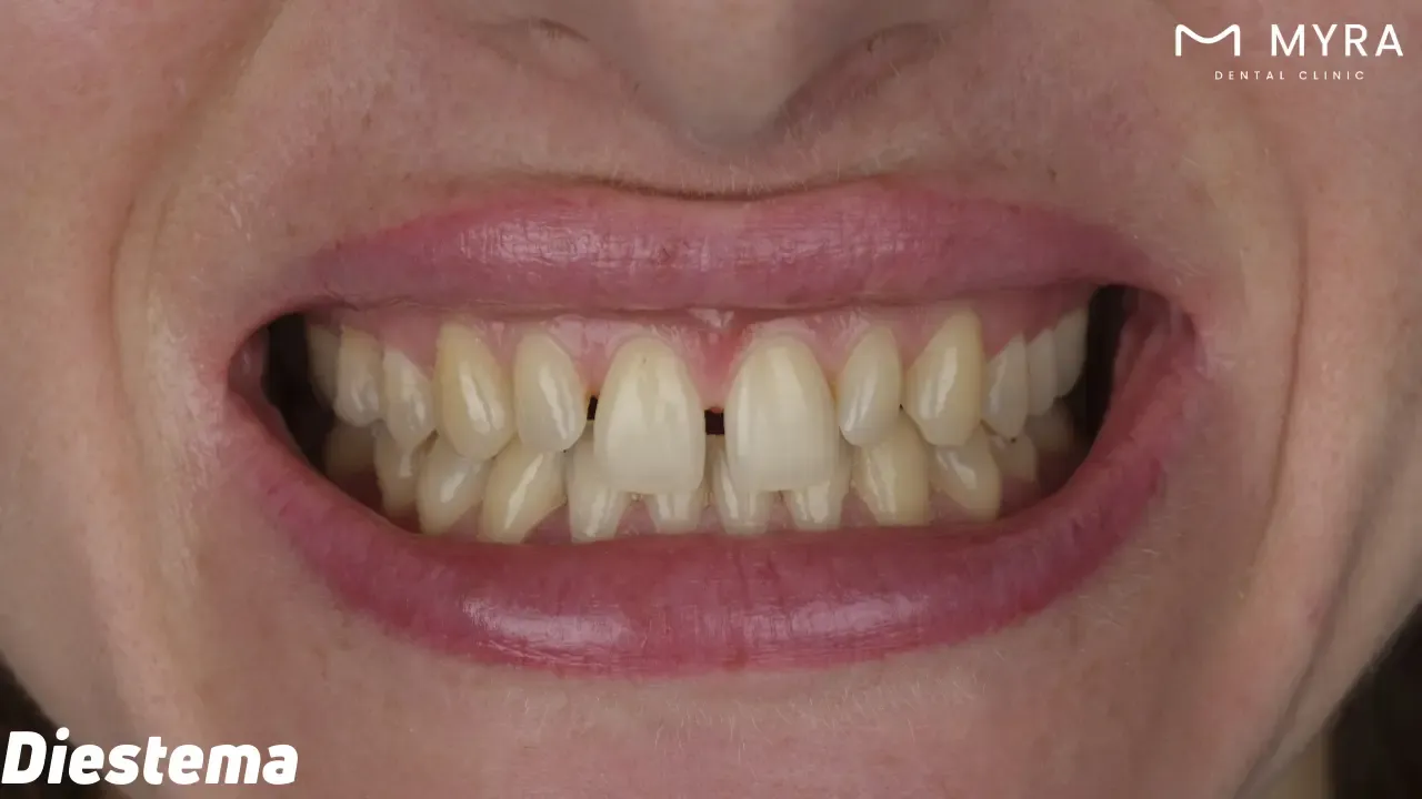 Diastema