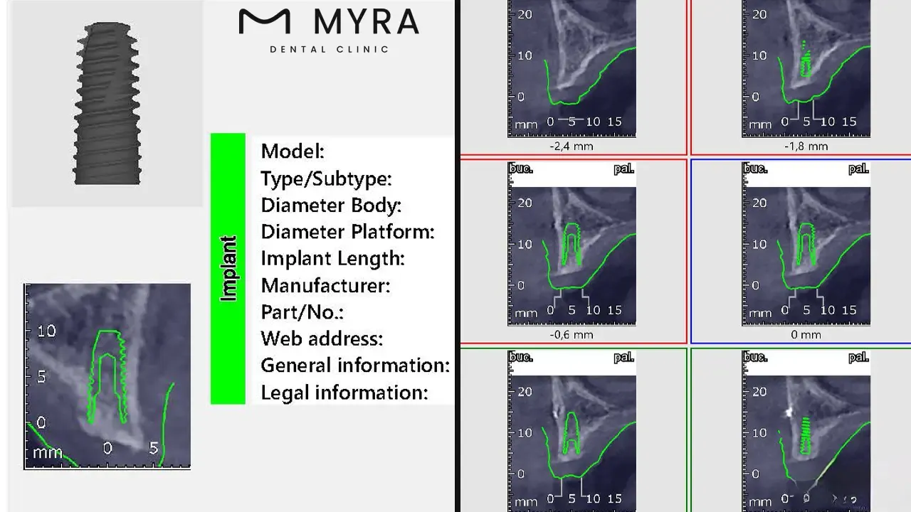 digital implant planning cerec