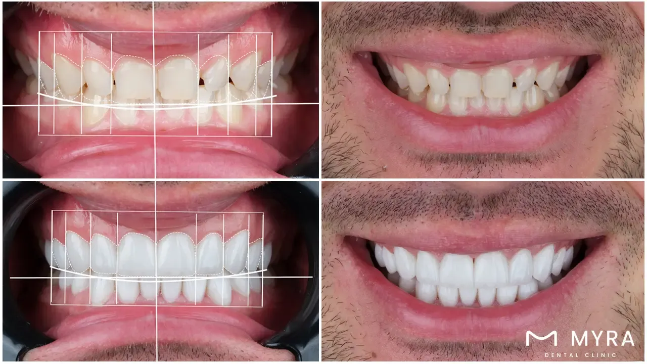 digital smile design