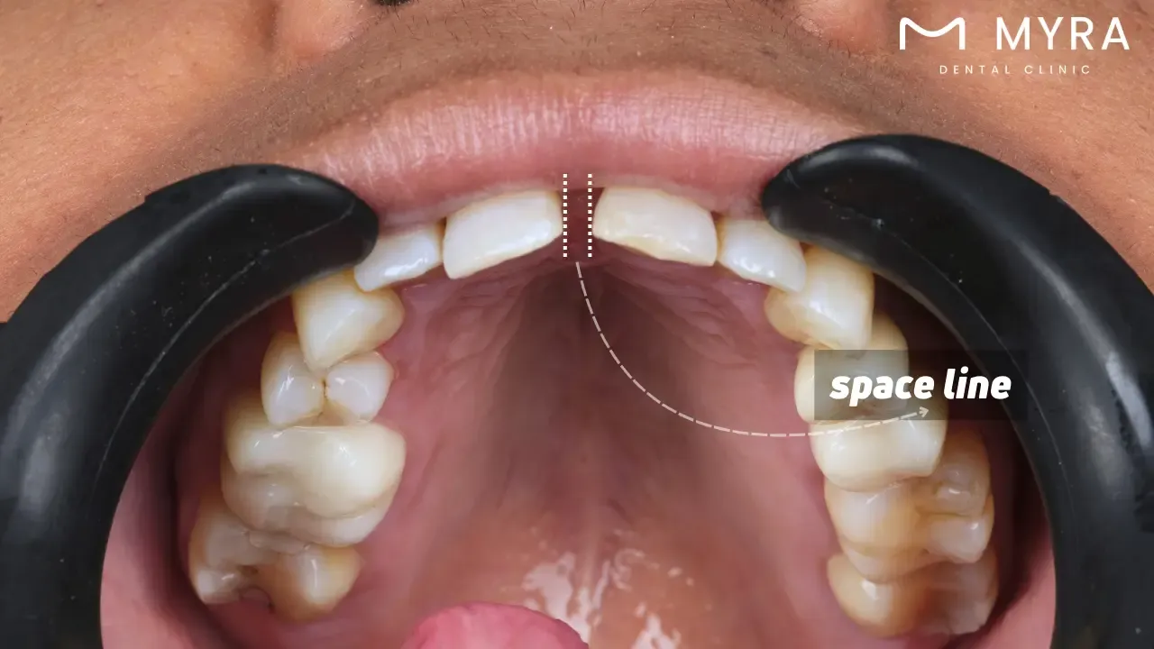 Does diastema have long-term side effects?