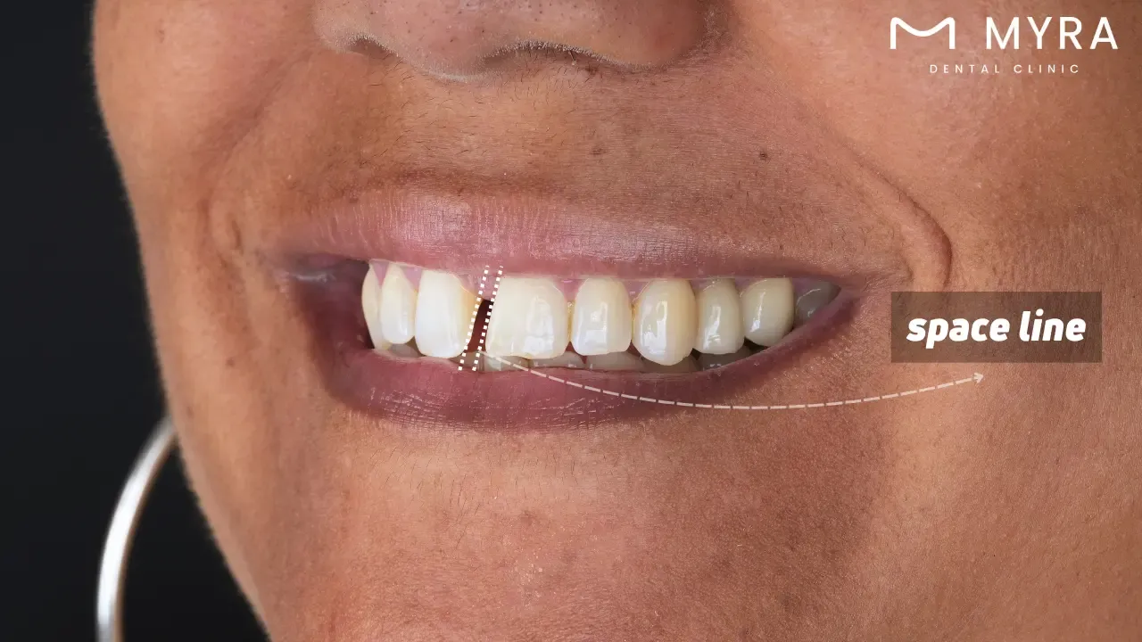 Does the size of tooth gaps increase with ageing?