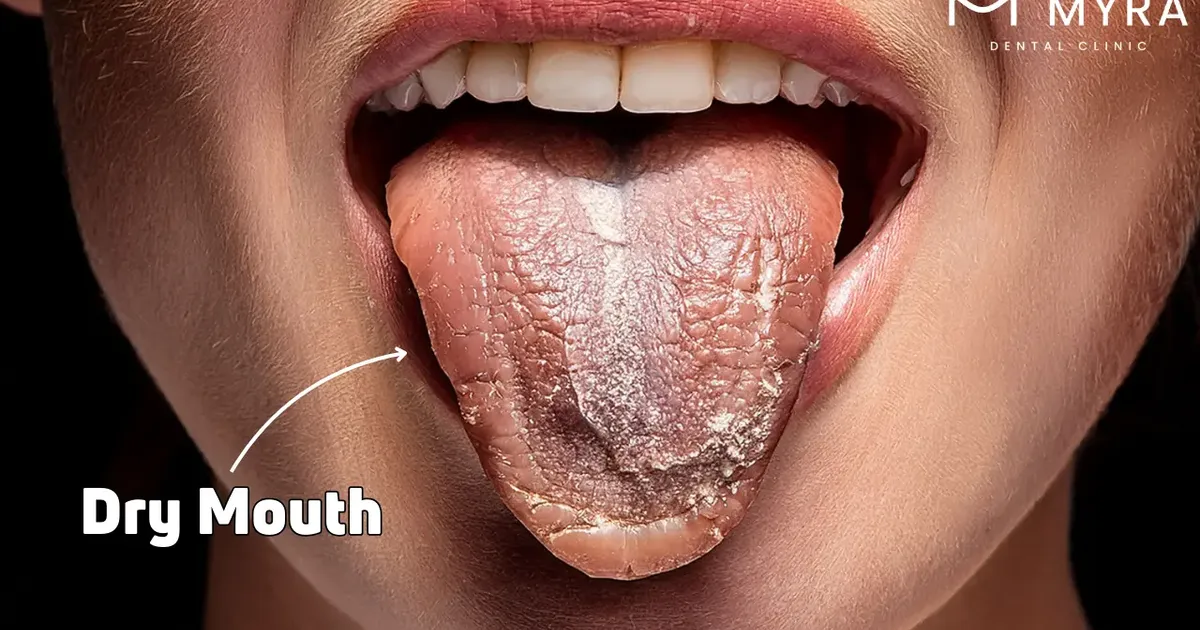 Dry Mouth: Symptoms, Treatment, Causes
