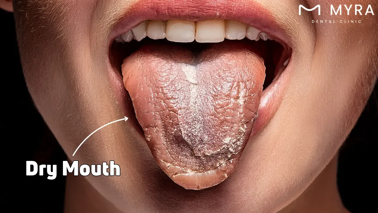 Dry mouth: Symptoms, treatment, and causes