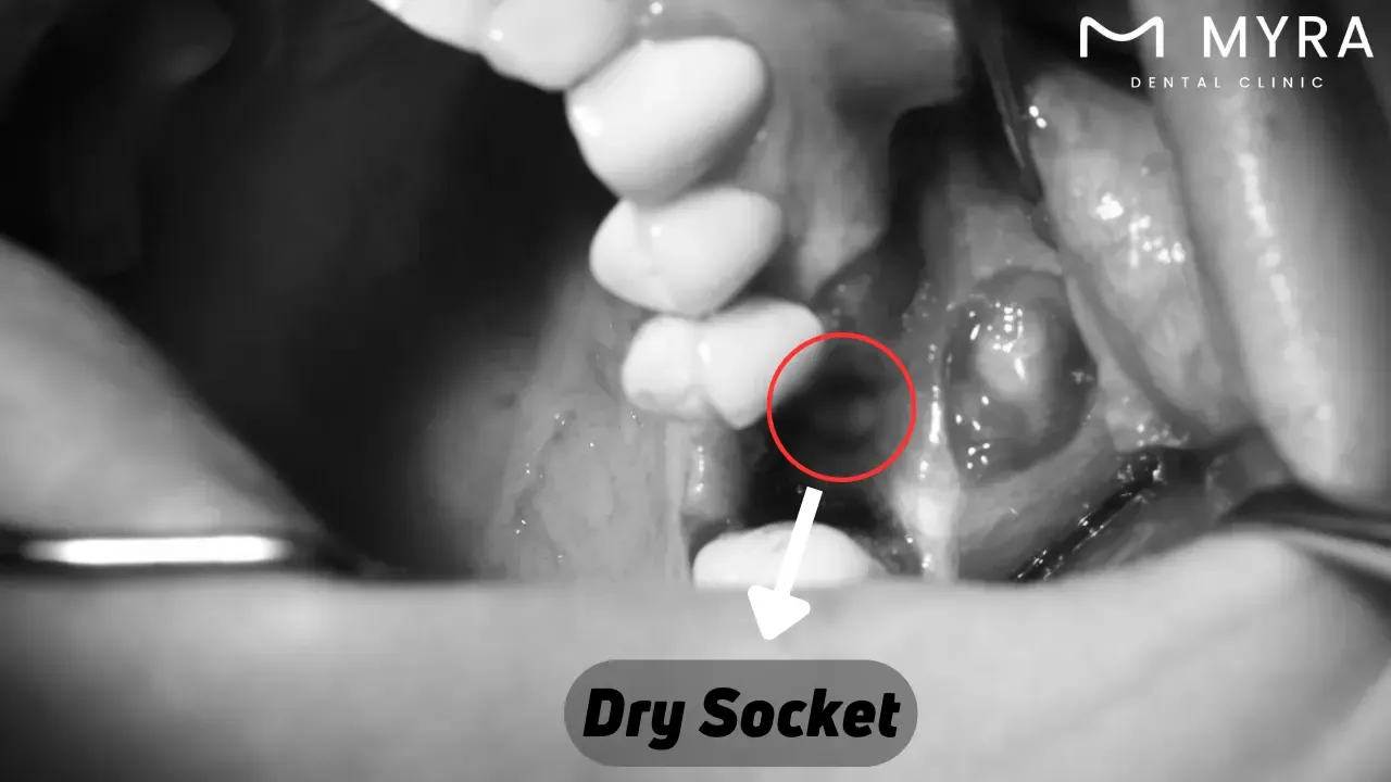 Dry socket: Symptoms, treatment, and causes