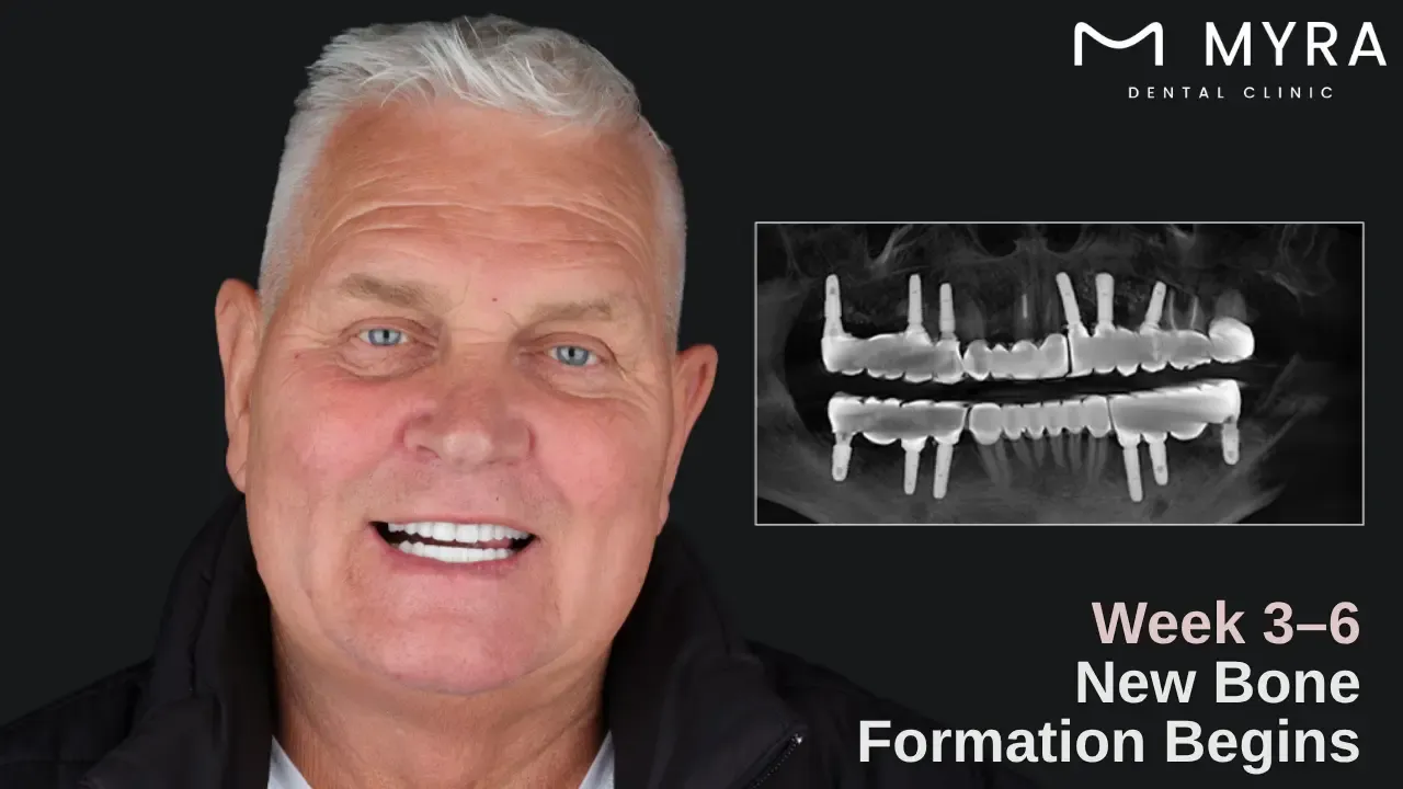 early bone regeneration