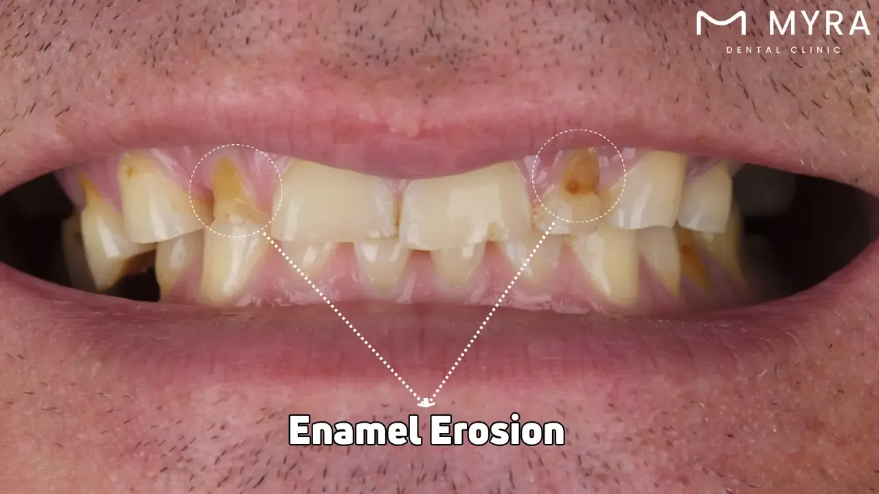 Enamel erosion
