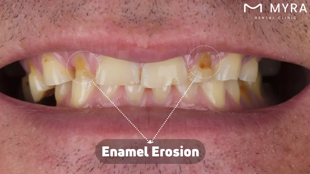 Enamel erosion: Symptoms, treatment, and causes